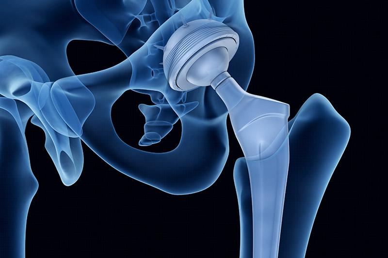 Illustration eines Hüftgelenk Implantats